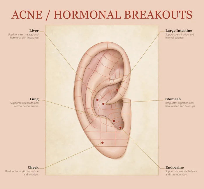 Acne & Hormonal Breakouts ear seed map