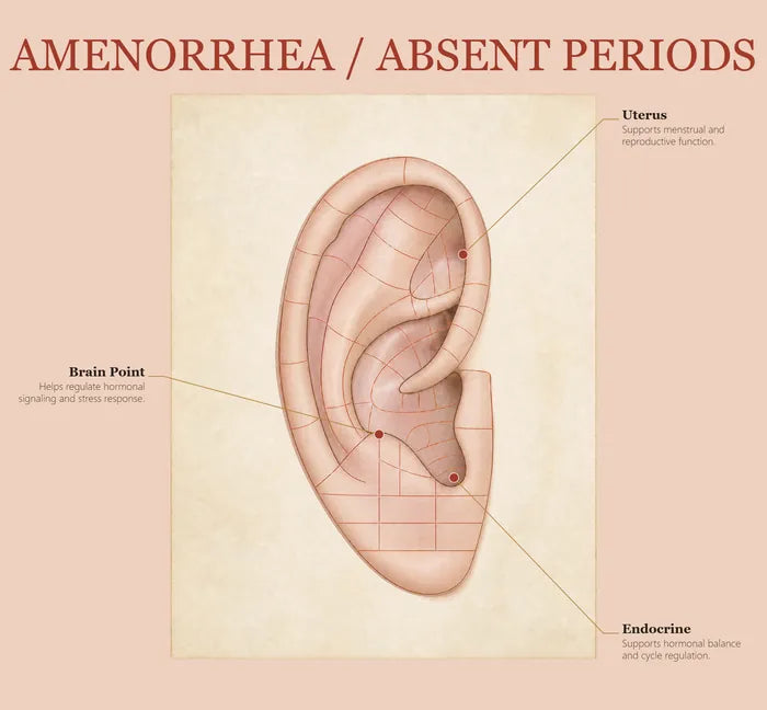 Amenorrhea (Absent Periods) ear seed map